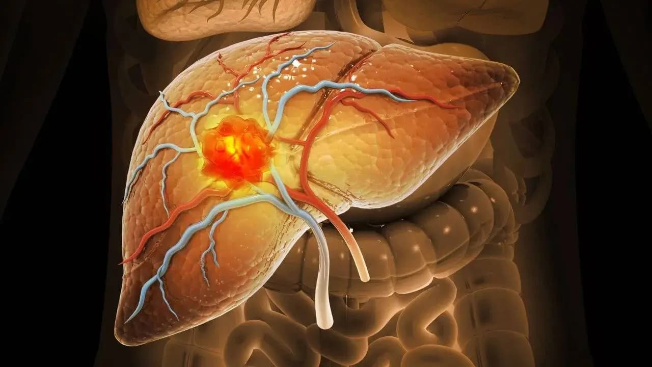 Fatty Liver Remedies