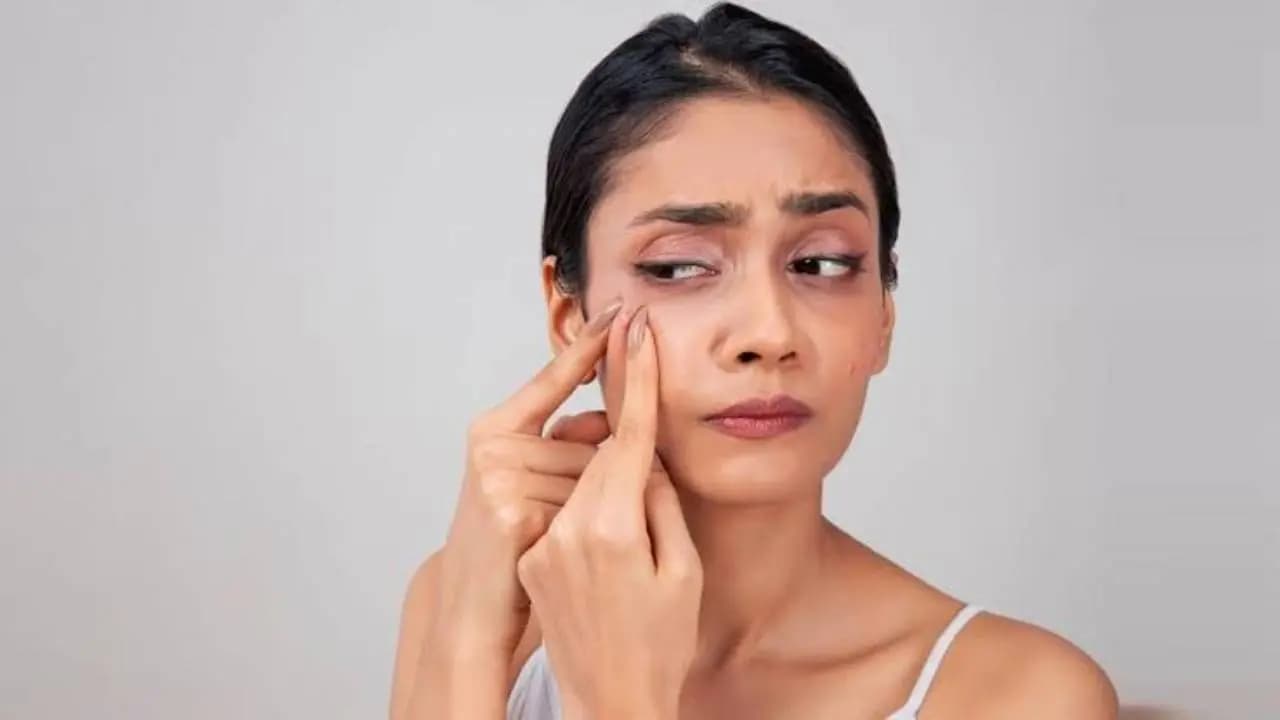 Foods to Avoid for Acne: Doctors Reveal Diet Changes That Stop Pimples