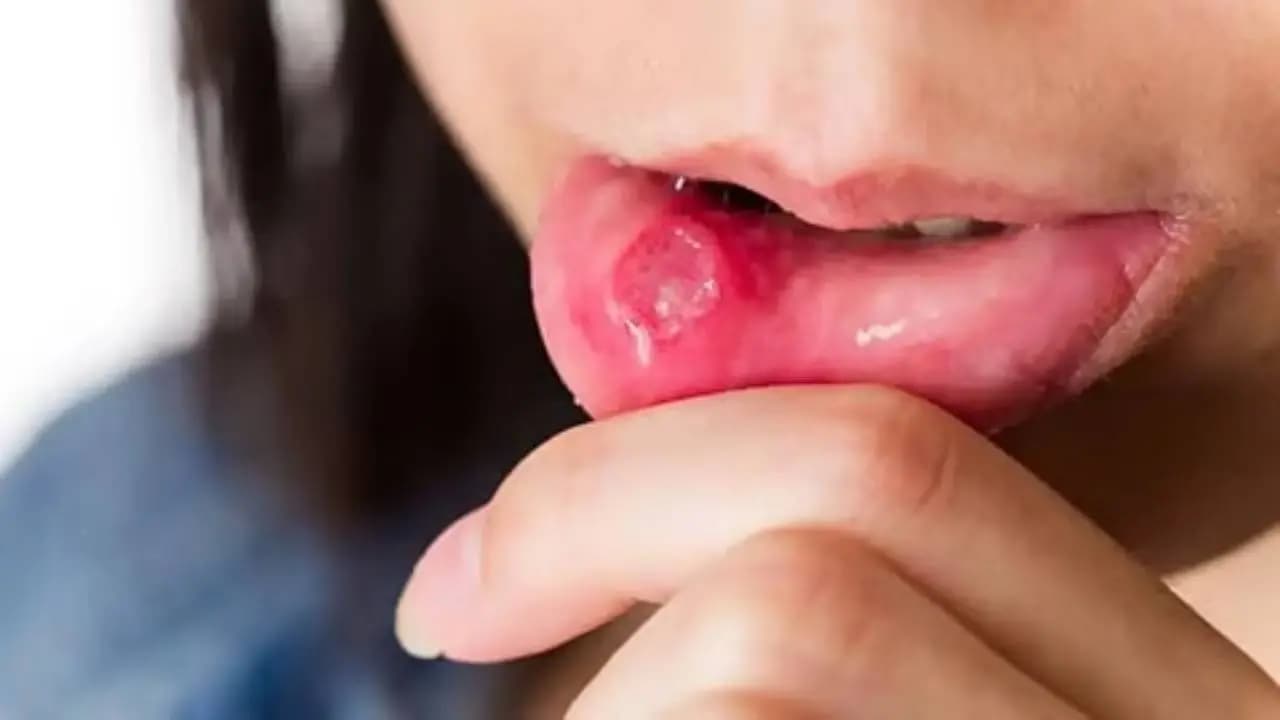 Early Signs of Oral Cancer