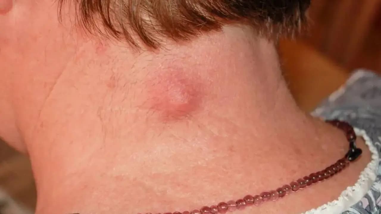 Vascular Malformation: Key Symptoms, Causes, and Doctor Consultation Guide