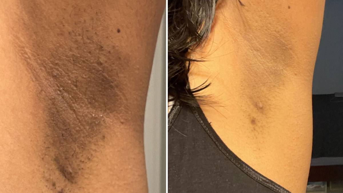 By these all tricks of home remedies can prevent dark spots of your underarms within one month