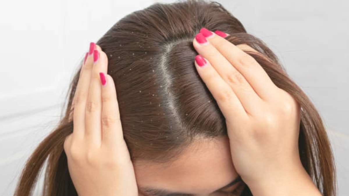 these all tricks can prevent dandruff and fungus problem and make your scalp healthy and clean