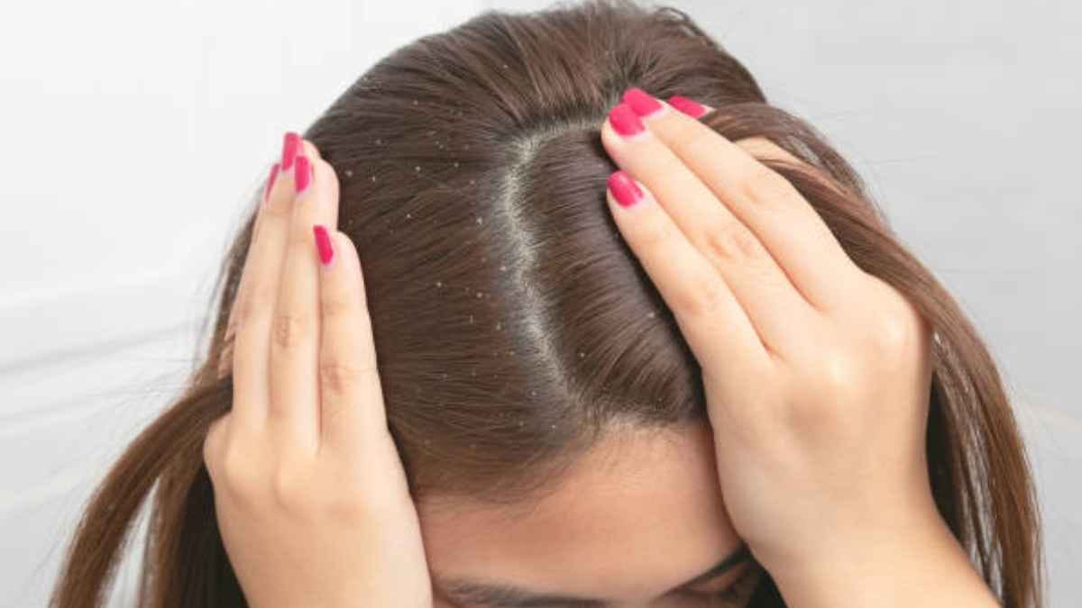  this home made natural shampoo can prevent dandruff problem and make your hair healthy 