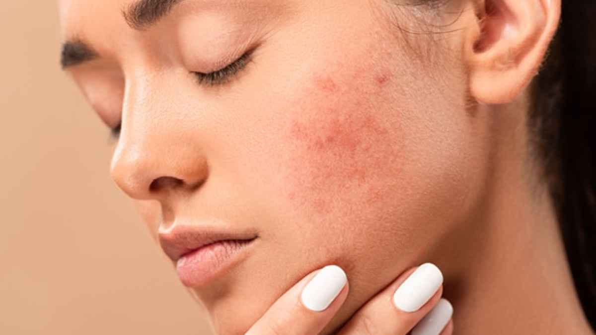  By using these all items with neem leaves can prevent acne problem rapidly 