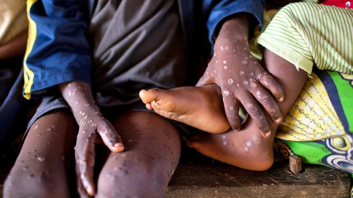 China has discovered the cluster of new Monkey Pox strain gnr