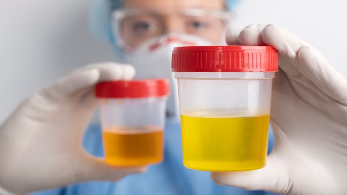 How the colour of urine can tell about your health lif