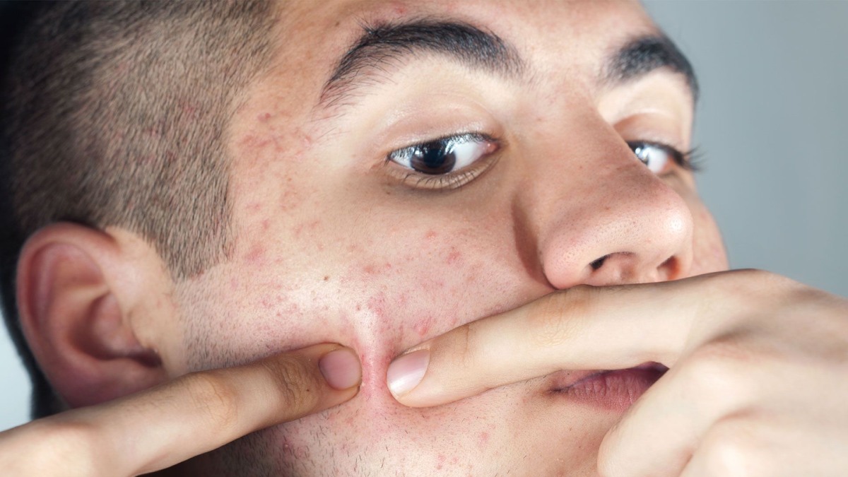 How to get rid of acne lif