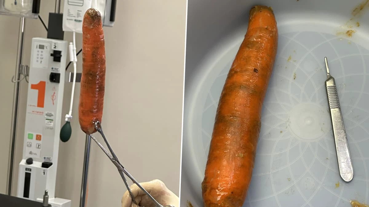 Customer puts a carrot inside rectum in a bizarre medical situation and the doctors warn about it